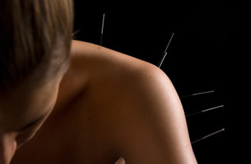 Acupuncture_treatment800