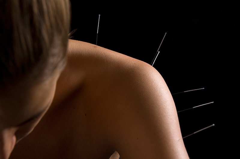 Acupuncture's Rise Expected: New York Times