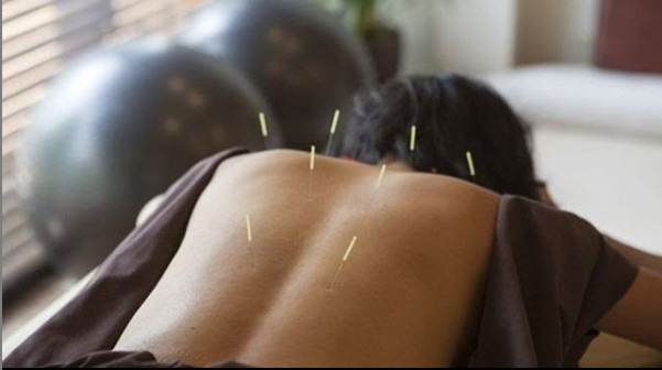 How to Find a Good Acupuncturist