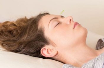 anxiety-acupuncture