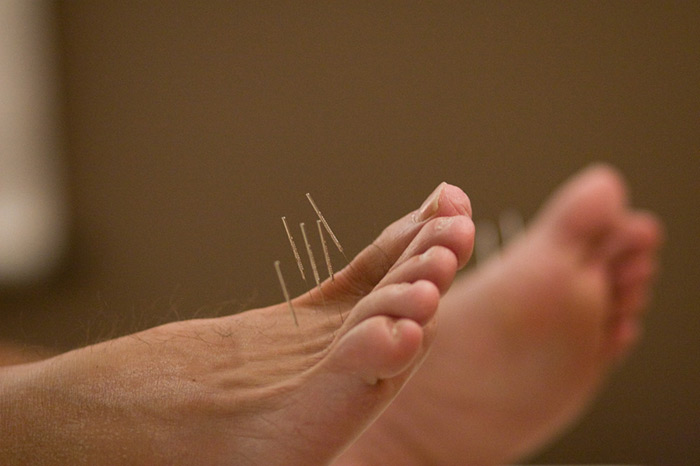 Neuropathy: Can acupuncture help with nerve pain?