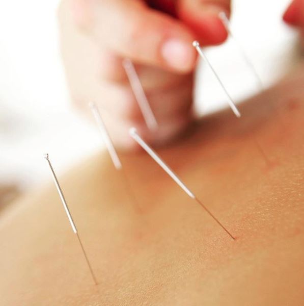How Acupuncture Can Help Your Immune System